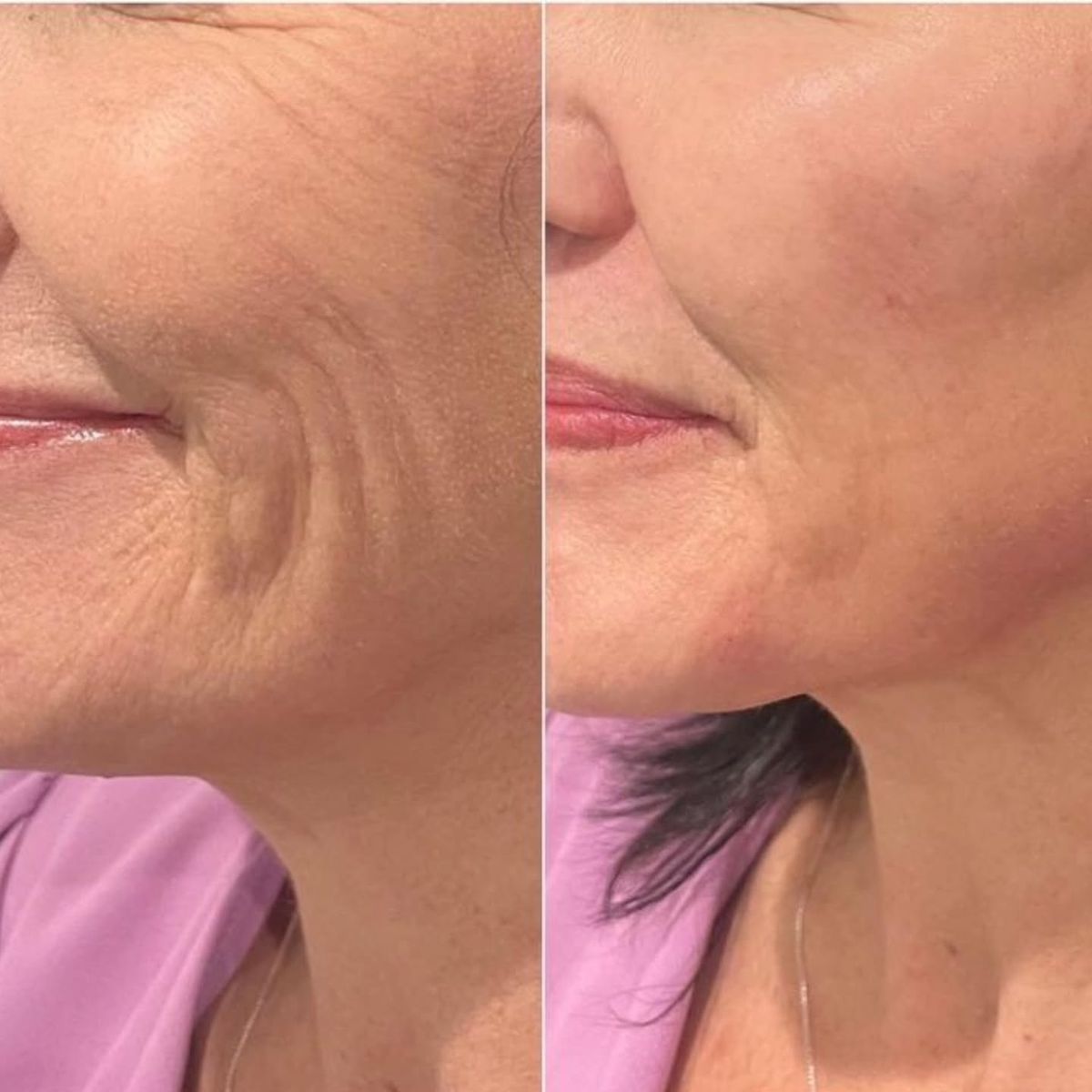 FaceLift Micro Wand 2.0
