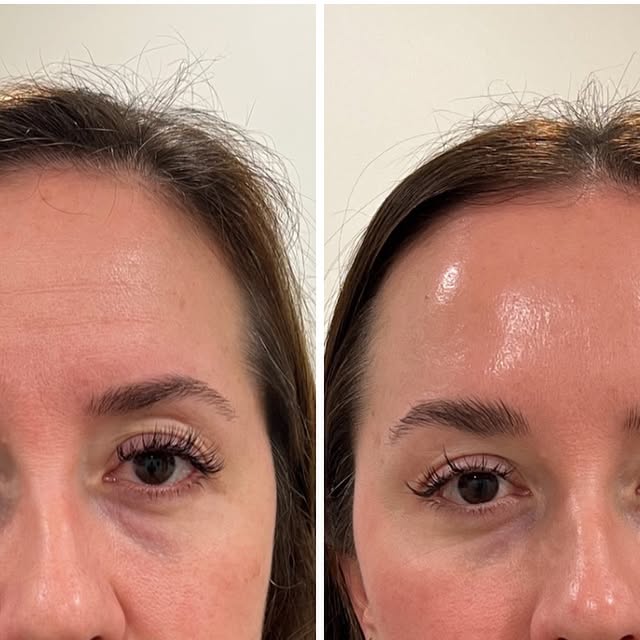 FaceLift Micro Wand 2.0