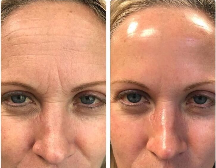 FaceLift Micro Wand 2.0