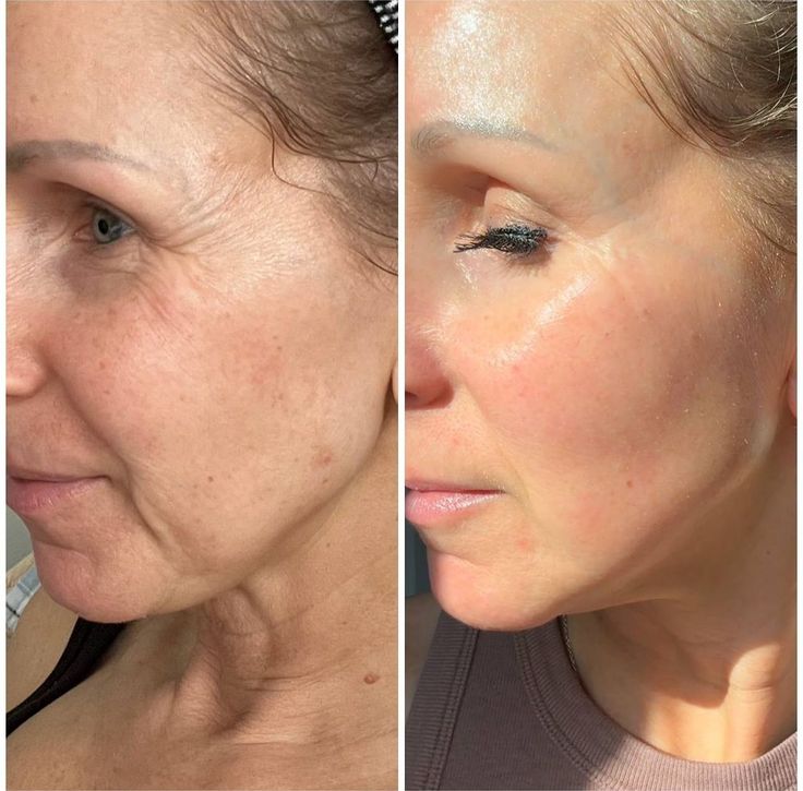 FaceLift Micro Wand 2.0